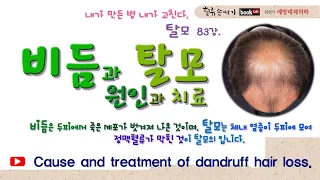 탈모 83강. 비듬과 탈모의 원인과 치료법. Cause and treatment of dandruff hair loss.