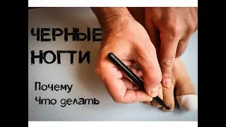 Черные ногти у бегунов. Почему и что делать