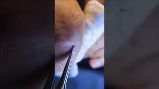ingrown hair pull out speedx2 with tweezers!  Satisfying 245 #shorts #satisfying  #well  #removal