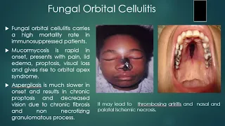 Orbital Cellulitis and Mnagement by Dr Shoaib Akram  Class 4th year