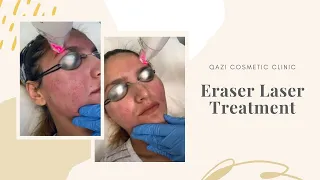 Eraser Laser Treatment | Live with Dr. Nadir Qazi