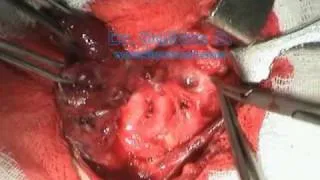 визуализация возвратного гортанного нерва