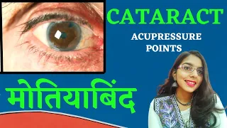 मोतियाबिंद / CATARACT ACUPRESSURE POINTS BY PURVI MARU