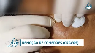 Comedão (Comedone) - Ep 03 (vídeo rápido - extração de cravos)