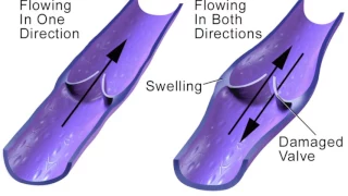 What are venous stasis leg ulcers? Complications of Venous Insufficiency | Texas Endovascular