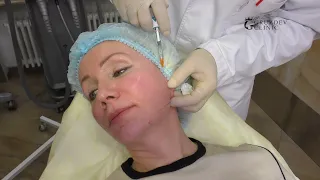 "Треугольник молодости". Филлеры  Juvederm.