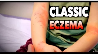 CLASSIC ECZEMA (Atopic Dermatitis) | Dr. Paul