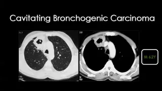 Imaging of Lung cancer Aug 2014   Dr Mamdouh Mahfouz In Arabic