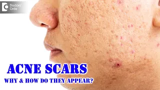 ACNE SCARS – Know The Causes | Deep Acne, Pus Filled Acne - Dr. Renuka Shetty| Doctors' Circle