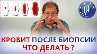 КРОВИТ ПОСЛЕ БИОПСИИ. Что делать? Последствия биопсии шейки матки при подозрении на миому в 71 год.