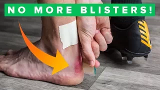 How to never get blisters again | Top 5 blister hacks