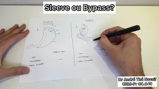 Como decidir entre Sleeve ou Bypass?