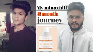 My 8 month minoxidil beard  journey|mars byghc5%|