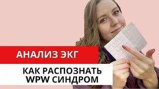 ЭКГ диагностика WPW-синдрома (синдром Вольфа — Паркинсона — Уайта). Синдромы предвозбуждения.