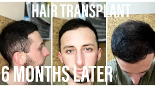 6 МЕСЯЦЕВ ПОСЛЕ ПЕРЕСАДКИ ВОЛОС В ТУРЦИИ / TRANSPLANT HAIR / Пересадка волос  FUE. ЛУЧШАЯ ИНВЕСТИЦИЯ