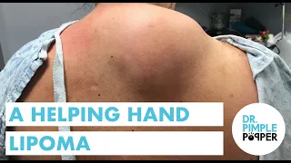 The Helping Hand Lipoma