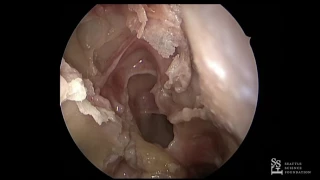 Lab Demo - Prosection: Sella Turcica, Suprasellar Approach & Cavernous Sinus - Sarah Wise, MD