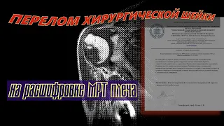 Аддукционный ПЕРЕЛОМ ХИРУРГИЧЕСКОЙ ШЕЙКИ плеча на расшифровке МРТ плечевого сустава