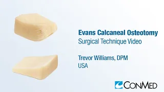 Dr. Trevor Williams - Evans Calcaneal Osteotomy - CONMED Surgical Technique