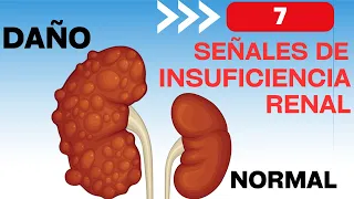 7 signs that you will have chronic kidney disease