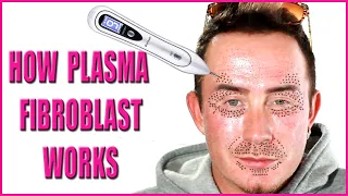 Plasma Fibroblast | How Fibroblast Plasma Works Beneath the Skin