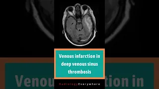 Venous infarction in deep venous sinus thrombosis |  Radiology tutorials | video 56