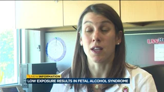 Even small amount of alcohol can cause fetal alcohol syndrome