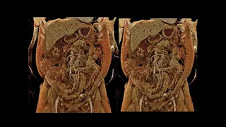 CT of Small Bowel Tumors: Detection & Classification Part 3