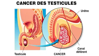 Le cancer des testicules, quels sont les symptômes et les causes de cette maladie
