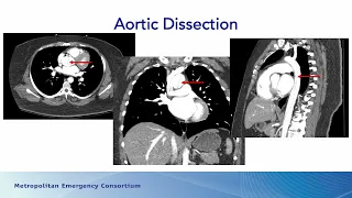 April 2024 MEC Minute: Vascular Emergencies