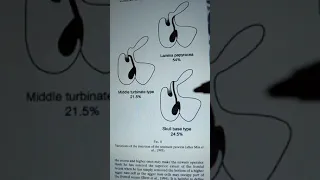 Variations in insertion of uncinate process