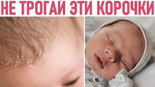 МОЛОЧНЫЕ КОРОЧКИ | Вот почему нельзя трогать молочные корочки у малыша