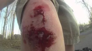 Longboarding crash aftermath