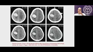 "Management of Intracranial Hemorrhage"-Lecture