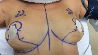 Breast Lift Surgery - Before and After - Dr. Anthony Youn