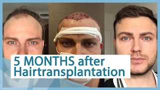 5 months after hairtransplantation - Elithairtransplant Dr. Balwi Turkey