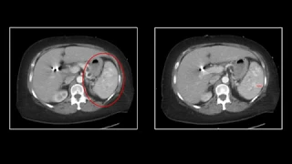 Viscus Trauma | Interesting Radiology Cases