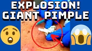 Giant Pimple Explosion Cyst Popping | Acne Pus Blackheads Bursting | ASMR Satisfying 36# 😱😱