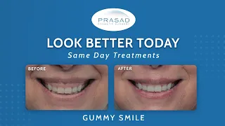 How Gums When Smiling/ Gummy Smile can be Treated in Minutes