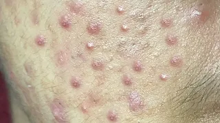 Huong Da Nang Acne Treatment #279