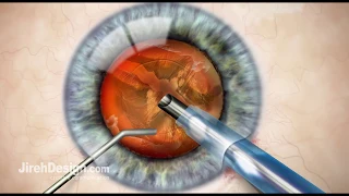 Phacoemulsification in Cataract Surgery [HD]