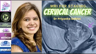 MRI FOR CARCINOMA CERVIX | DR PRIYANKA GAHLOT | FIGO CLASSIFICATION IN STAGING OF CA CERVIX | PET CT