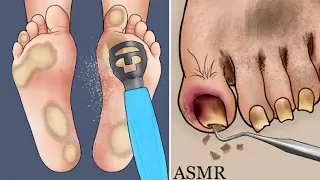 Asmr Satisfying! Foot Wart Treatment | Screw Nail Removal | Tingle Sounds|Asmr Coolness!Ingrown Nail