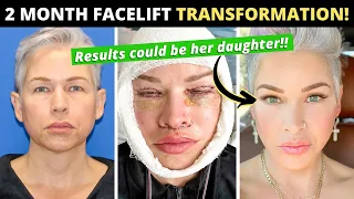 49 Year Old Turns Back the Clock 10 Years with Facelift and Lip Lift! Two Month Facelift Journey