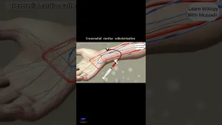 Transradial Cardiac Catheterization _ #animation  #shortvideo