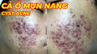 Điều trị mụn nang hiệu quả tại TPHCM | Hiền Vân spa | Cyst Acne Treatment | 681