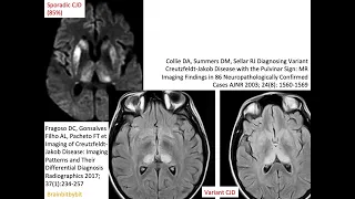 55. Creutzfeldt-Jakob disease; mad cow bovine spongiform encephalopathy, prion, progressive dementia