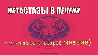 Поражение печени.  ОЧАГИ в печени на КТ РАСШИФРОВКЕ брюшной полости. МЕТАСТАЗЫ в печени (симптомы).