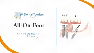 All on Four Ciudad Juarez - Dental Tourism Mexico