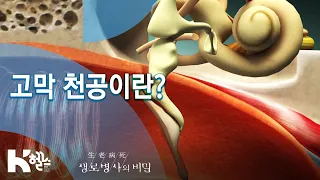 [생로병사의 비밀] 712회 핫클립👀 - 👉고막 천공👈이란?